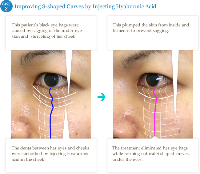 case2 Improving S-shaped Curves by Injecting Hyaluronic Acid 