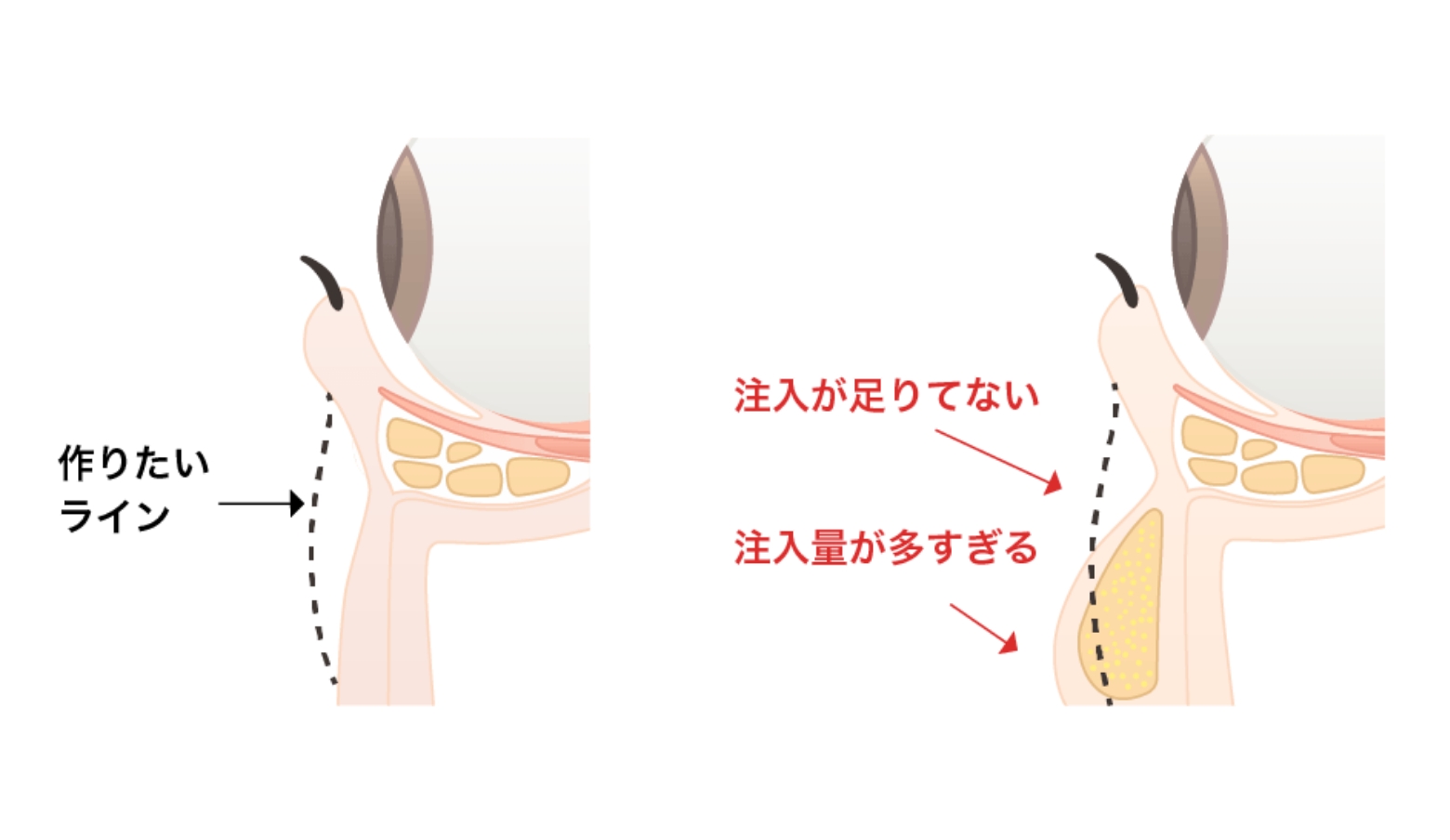 注入する場所