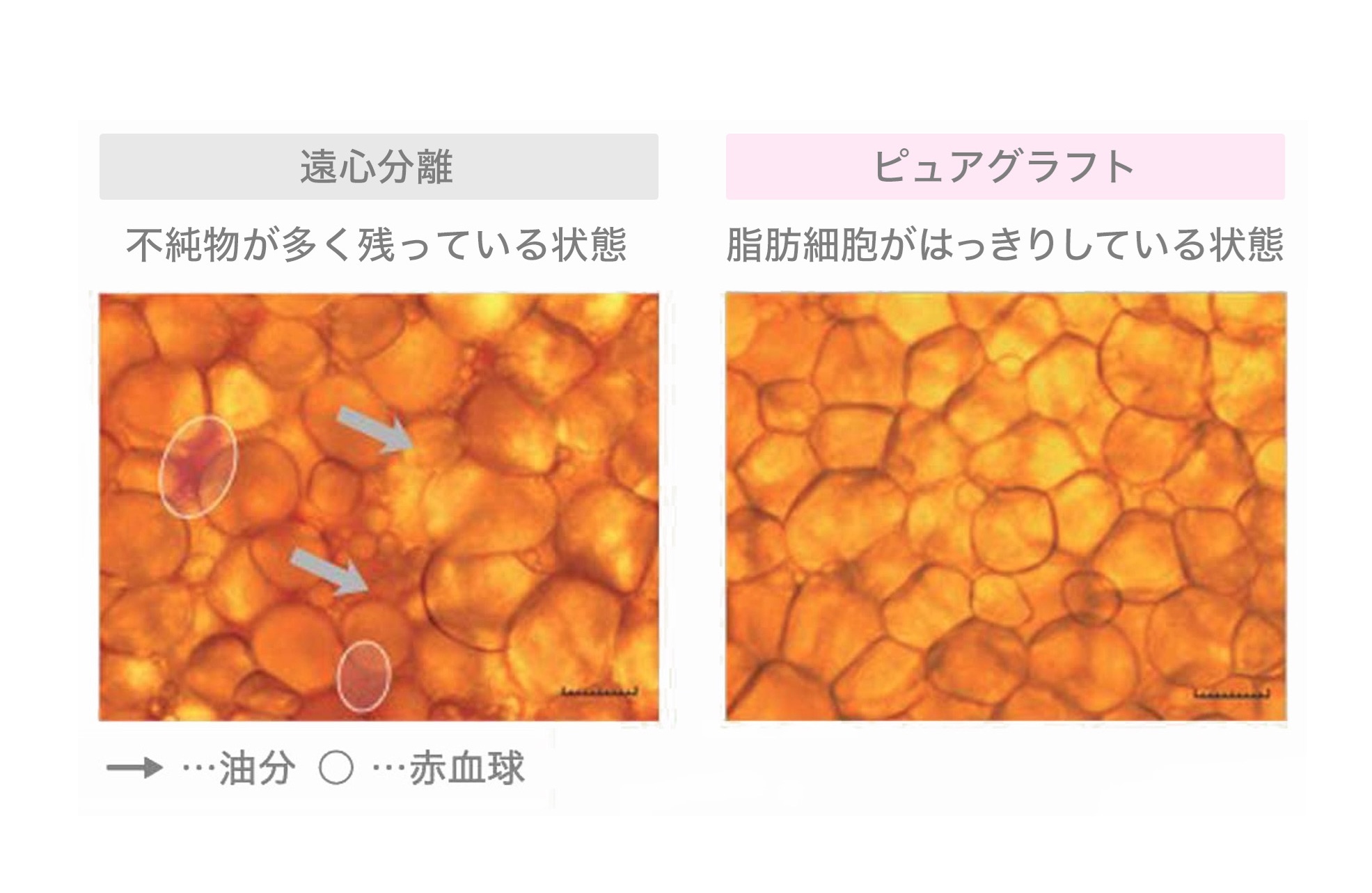 注入する脂肪の質