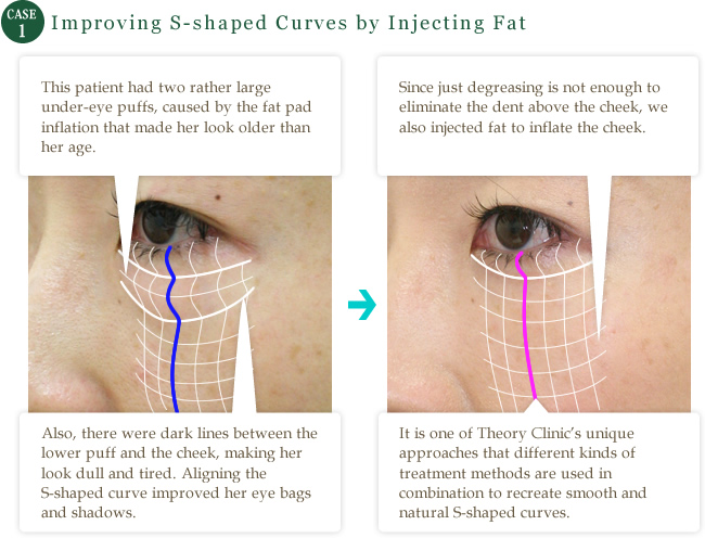 case1 Improving S-shaped Curves by Injecting Fat