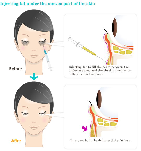 Injecting fat under the uneven part of the skin