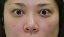 症例ギャラリー 腫れない目の下のクマ たるみ治療 銀座セオリークリニック