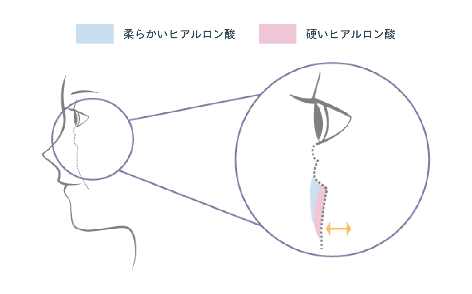 頬の高さを意識した注入