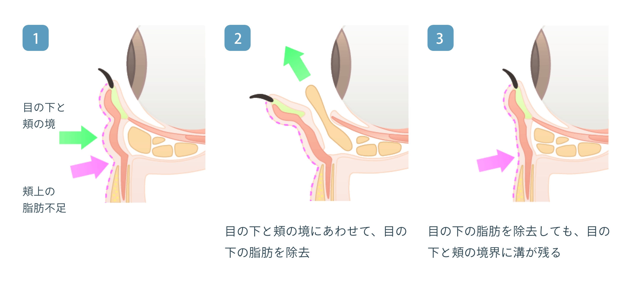 経結膜脱脂 + リポトランスファー + 脂肪注入