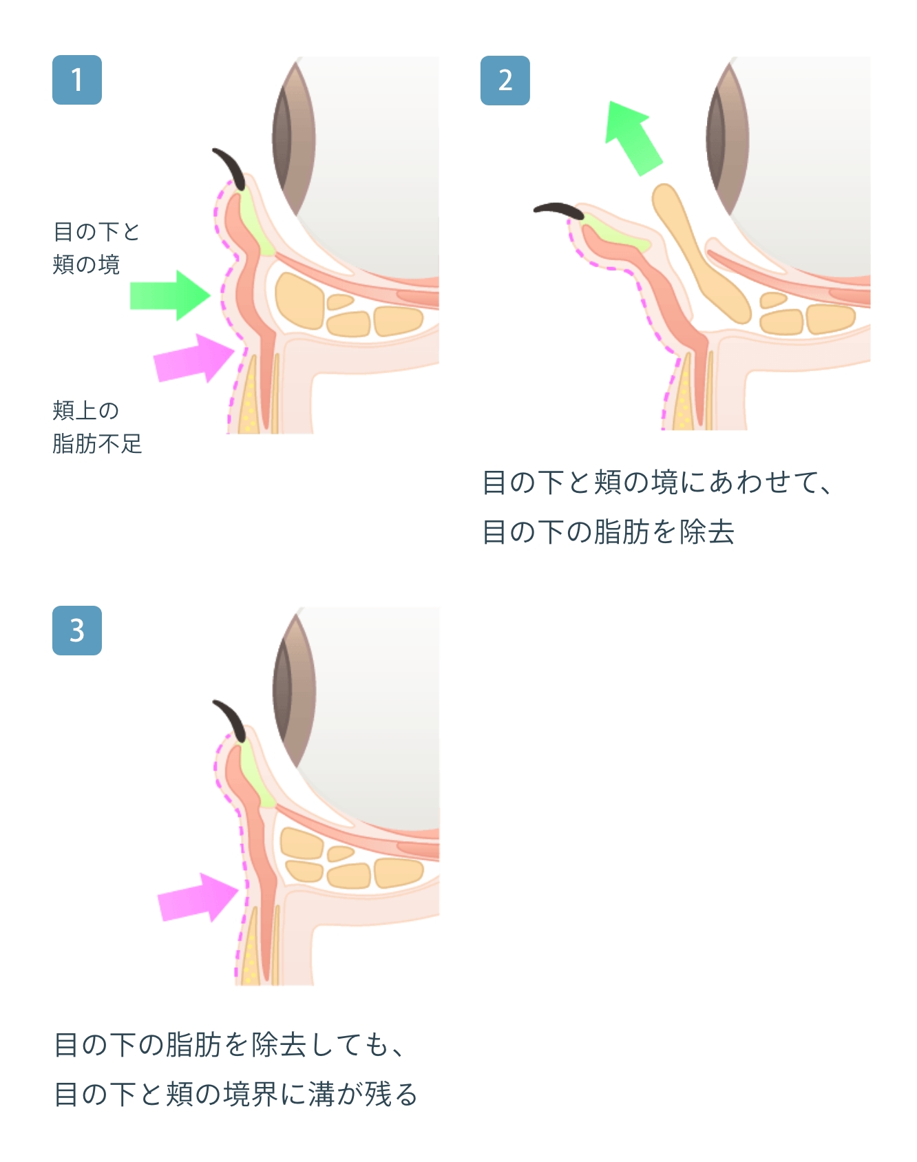 経結膜脱脂 + リポトランスファー + 脂肪注入