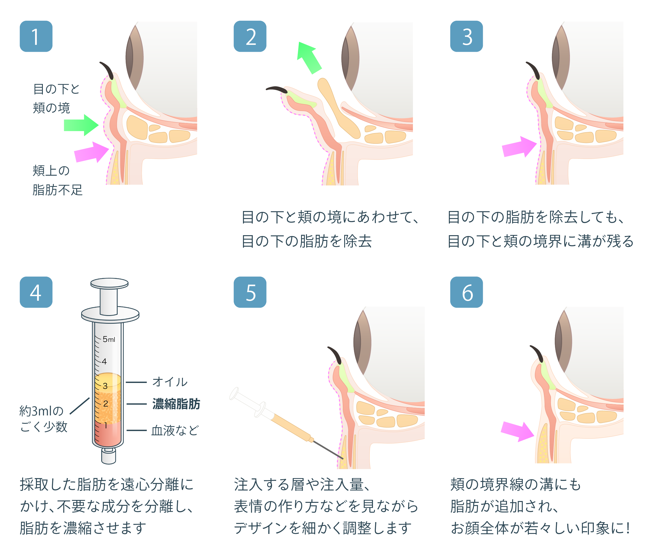 経結膜脱脂+リポトランスファー