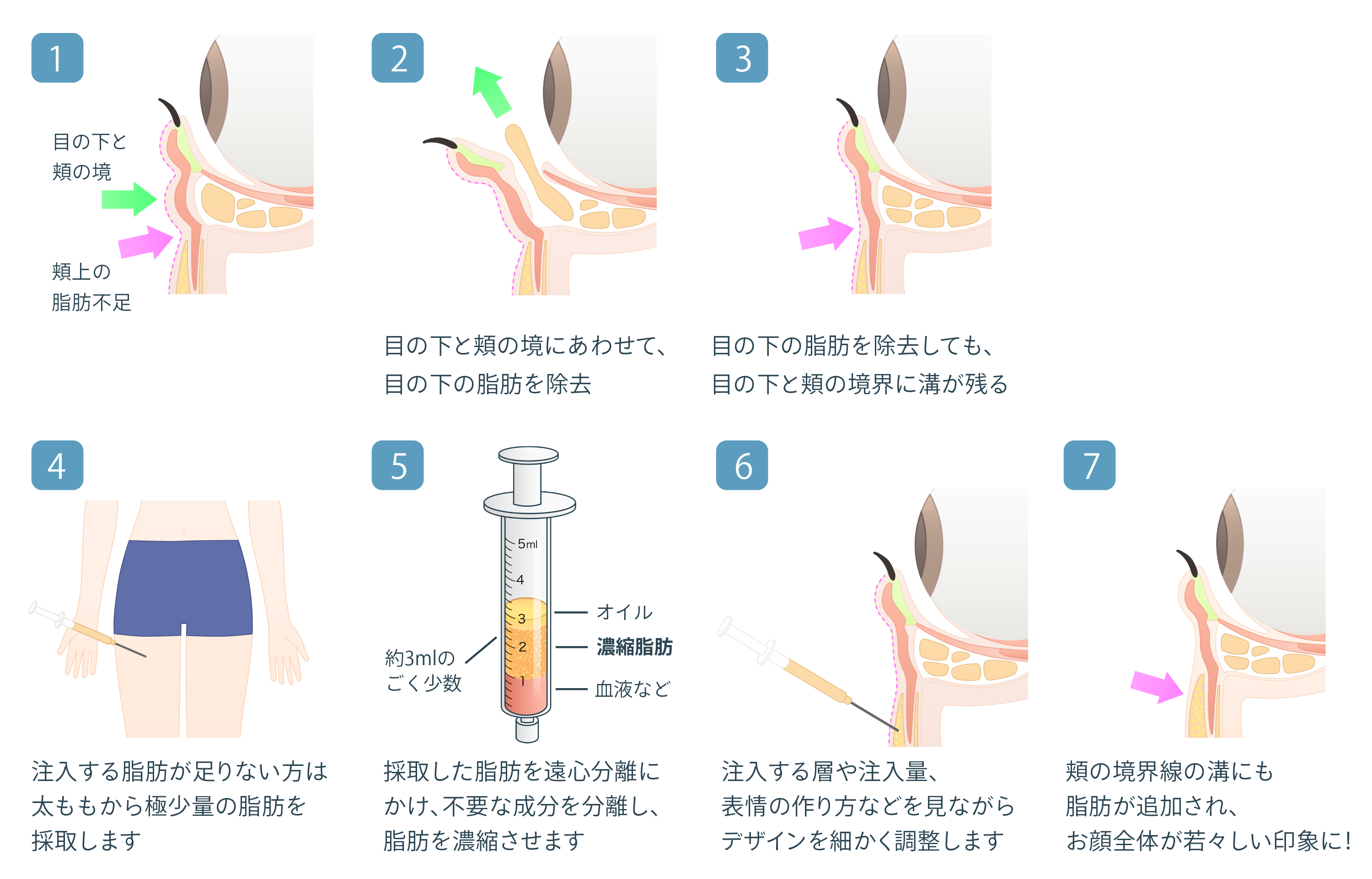 経結膜脱脂 + リポトランスファー + 脂肪注入