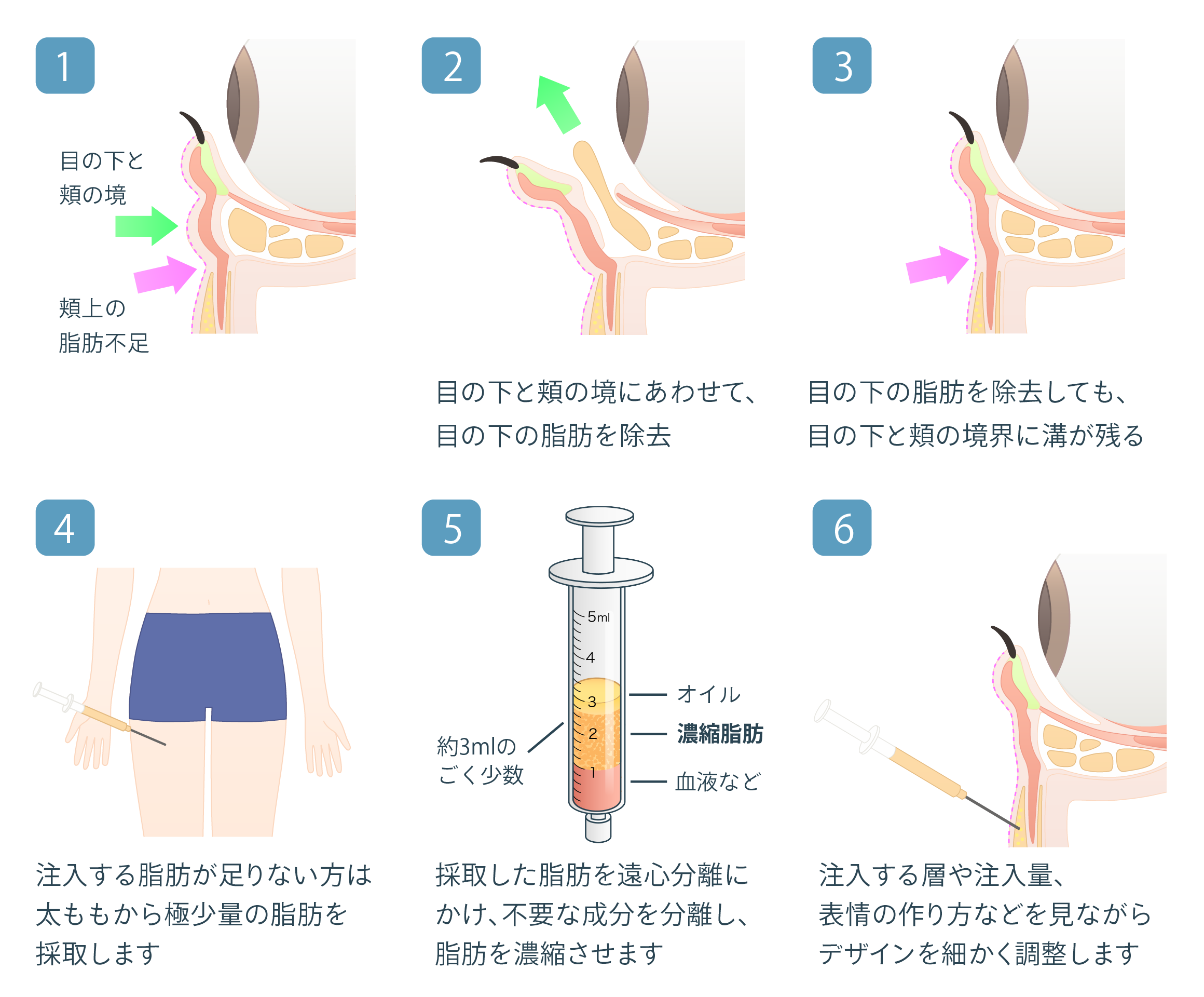 経結膜脱脂 + リポトランスファー + 脂肪注入