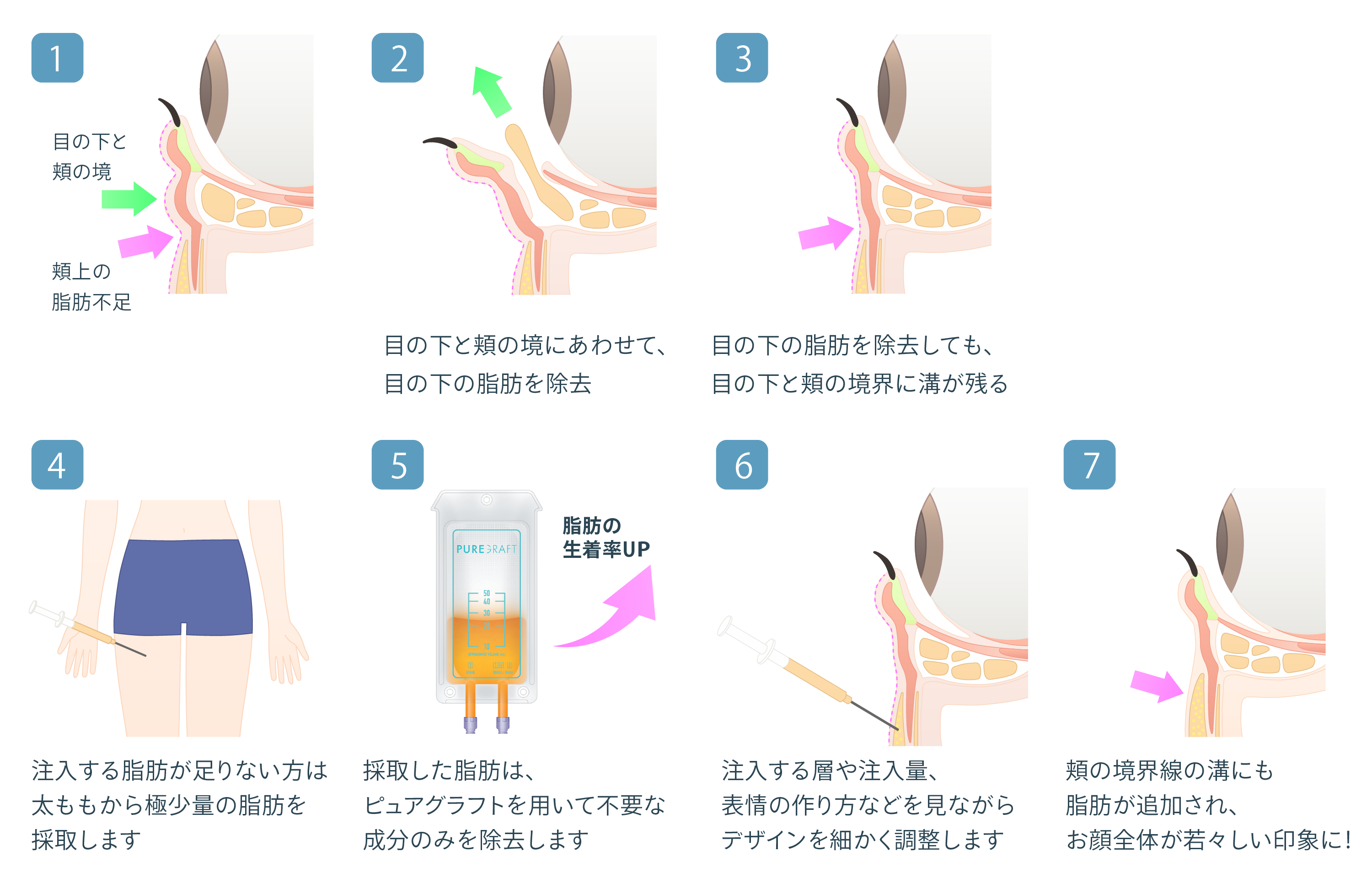 経結膜脱脂+ピュアグラフティング