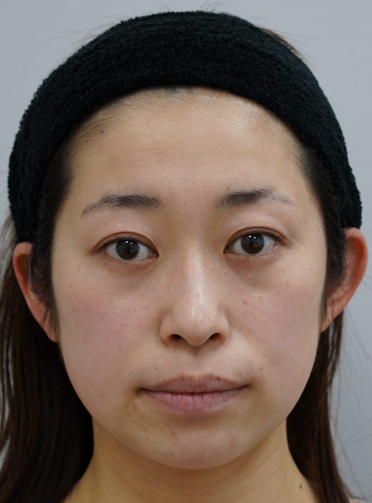 症例 Before