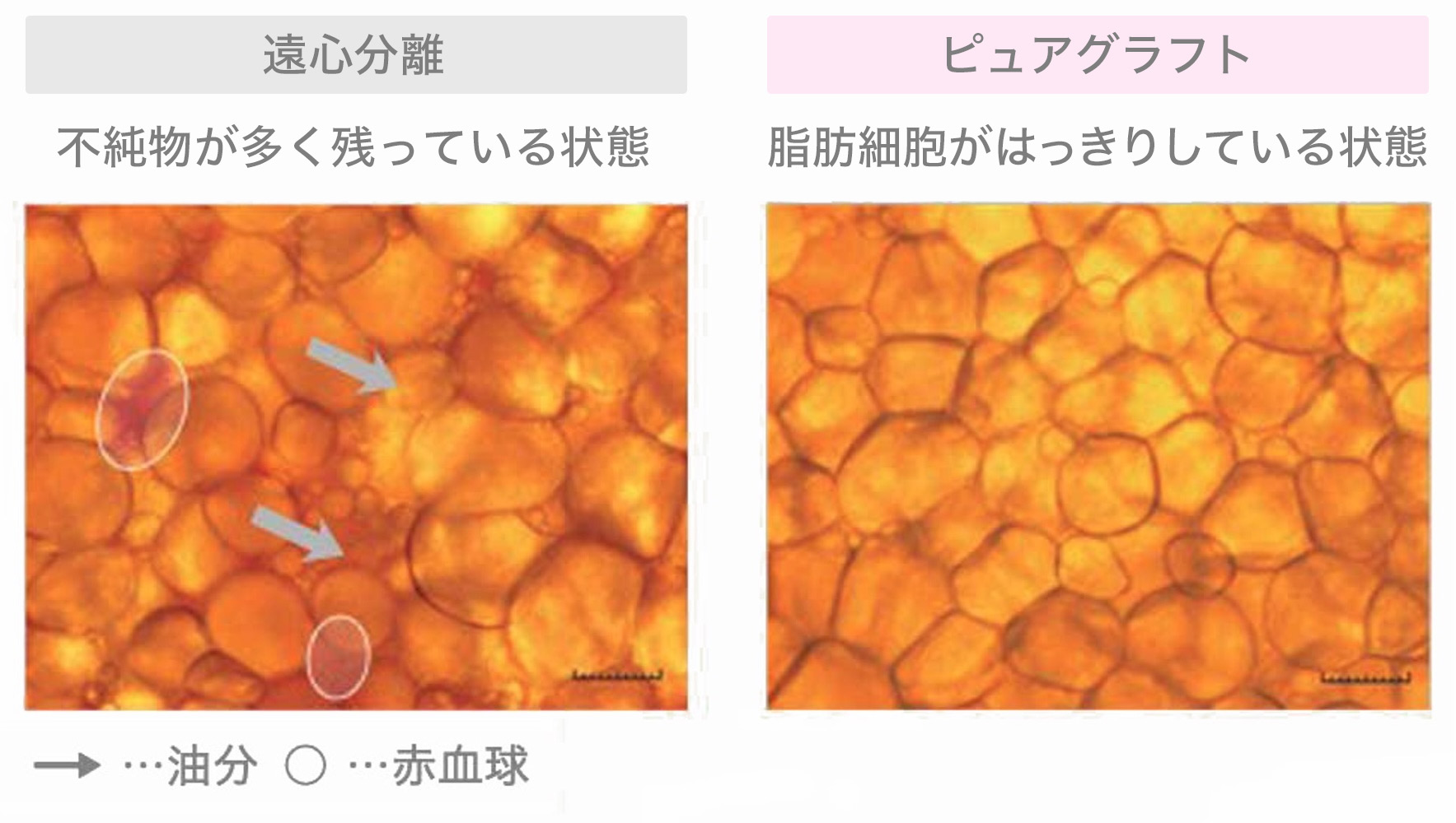 経結膜脱脂+ピュアグラフティング